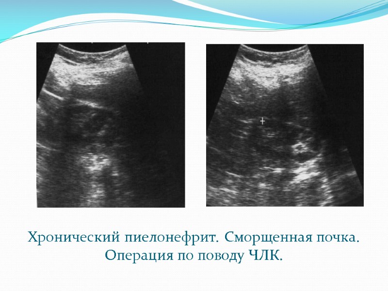 Хронический пиелонефрит. Сморщенная почка. Операция по поводу ЧЛК.